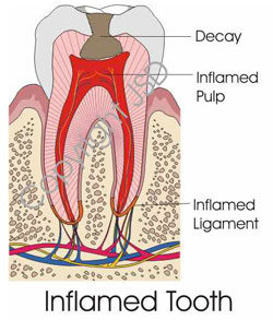 inflammedtooth.jpg